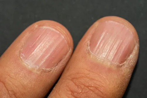 Why Nails Become Weak with Age