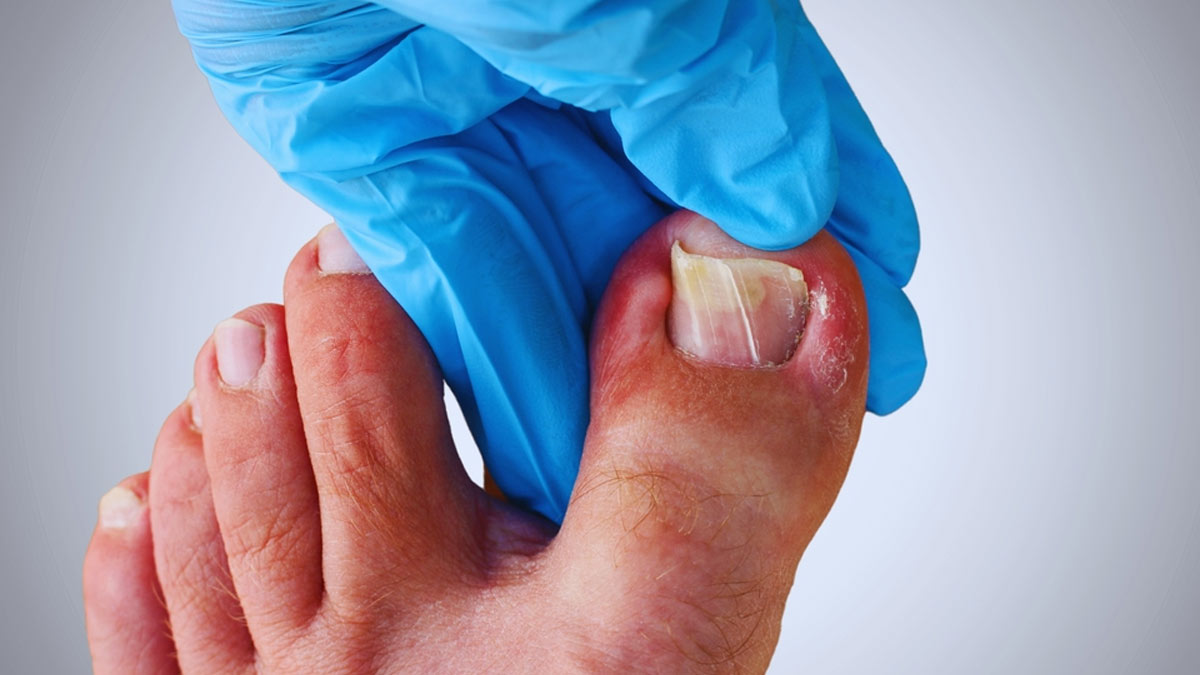 Nail Care for Seniors with Diabetes