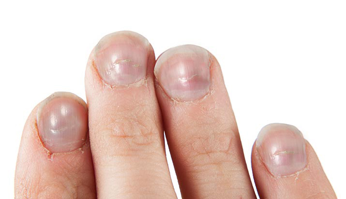 how to fix ridges in nails