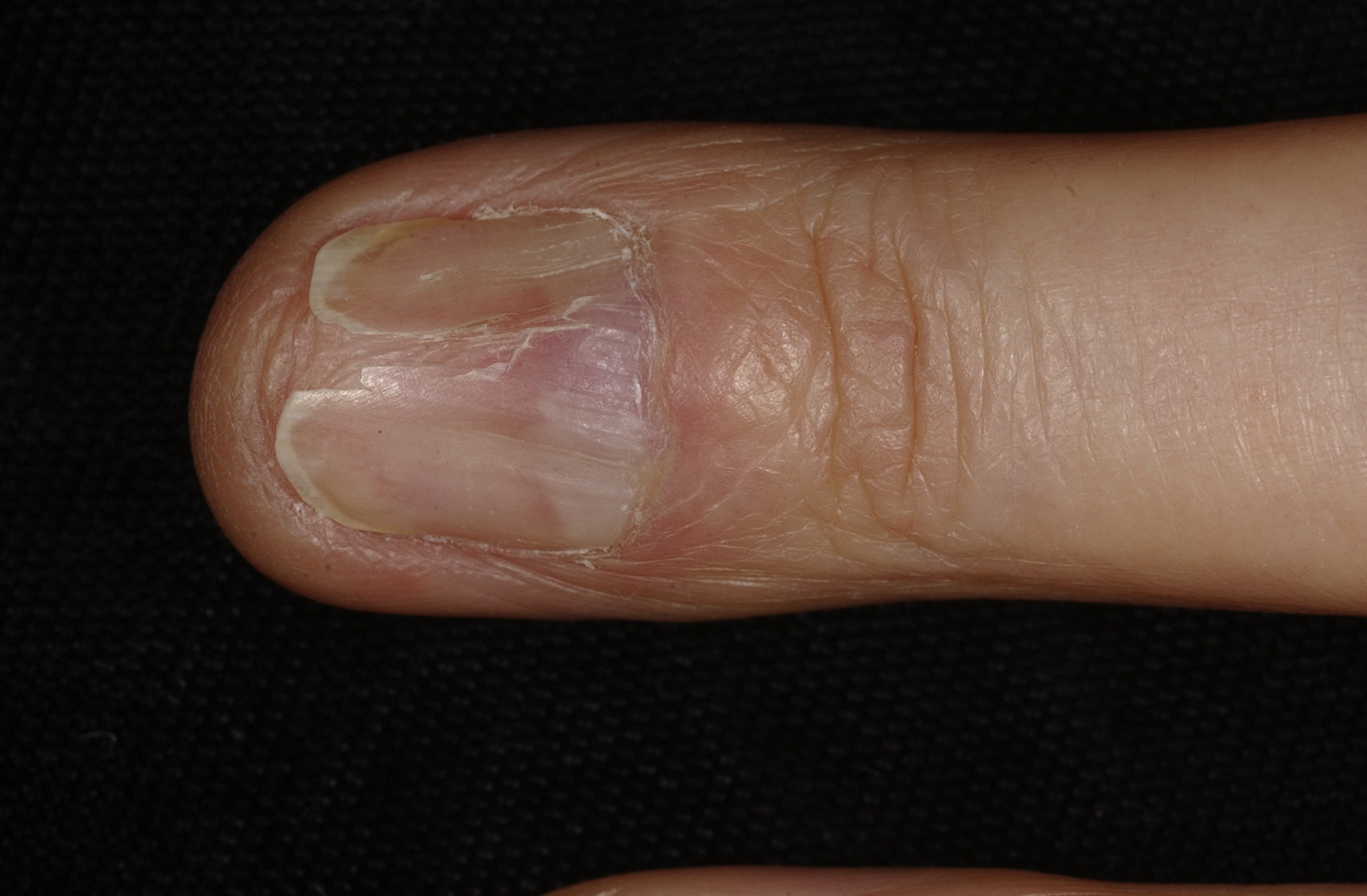 why nails split in the middle